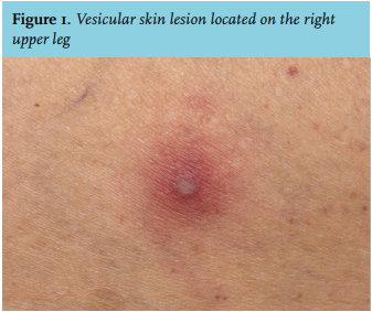 Article: A patient with fever and skin lesions after vacation in South ...